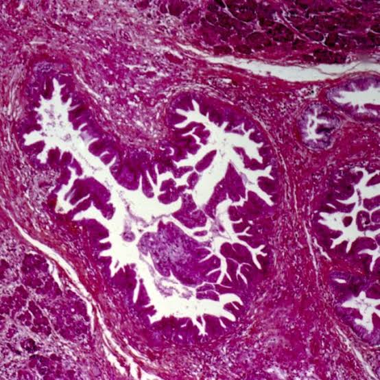 A turning point for pancreatic cancer patients