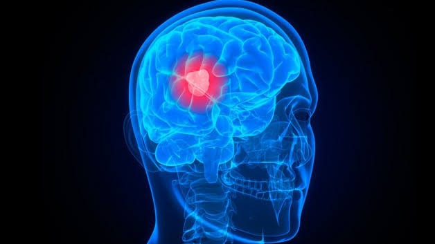What is glioblastoma and why is it so hard to treat?