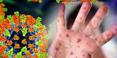 Delaware confirms second measles case, both in Kent County