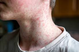 Utah leads nation in measles cases, no new Wasatch Back cases