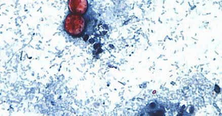 Northern Nevada Public Health reports first cyclosporiasis case in Washoe County