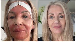 I’m 74, But the Needle-Free Croton Peel Makes Me Look Decades Younger