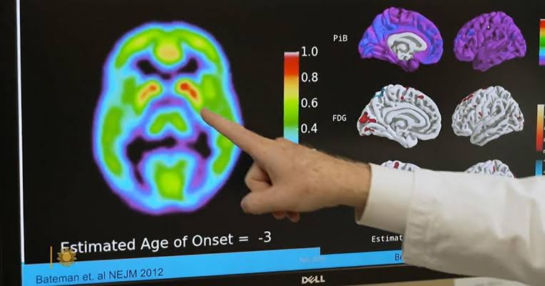 Alzheimer's blood test may predict who's likely to develop symptoms in 5 to 10 years