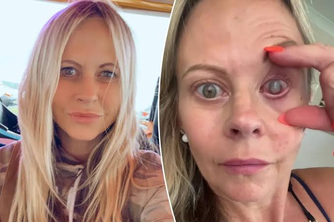 My eye had to be sewn shut after a parasite ate my cornea — the crucial mistake I made