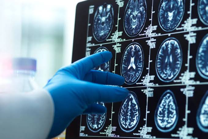 One Protein May Prevent Brain Process Linked to Alzheimer’s and Parkinson’s