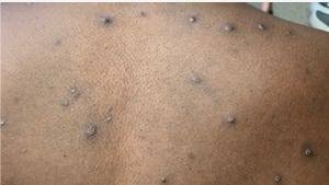 Arizona confirms first case of deadlier mpox strain
