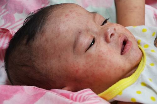 N.J. reports first measles case of 2026. Resident may have exposed others at 2 locations.