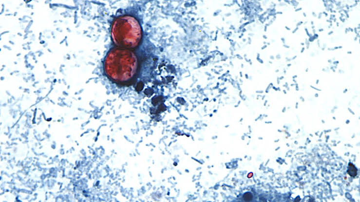 Doctor warns against ‘cyclospora skinny’ trend