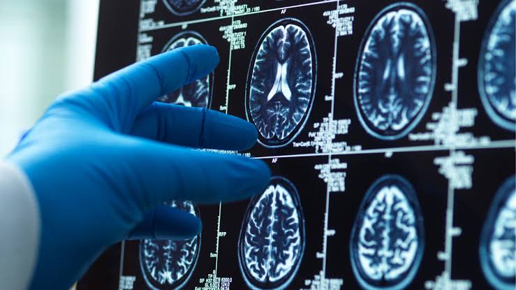 WHO says almost half of dementia cases ‘preventable’ with new health guidelines