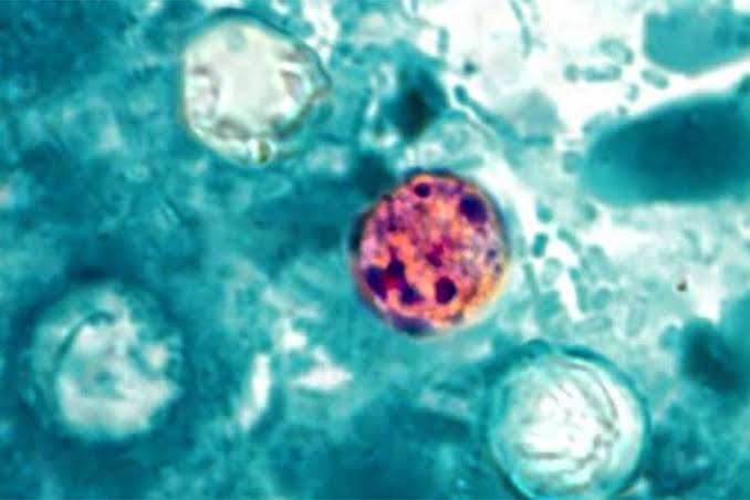 31 States Report ‘Explosive’ Diarrhea Cases Linked to Cyclosporiasis