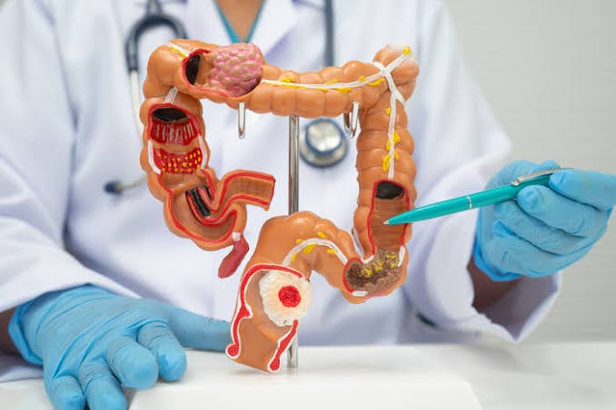 Here Are 3 Things You Can Actually Do To Lower Your Risk Of Colorectal Cancer