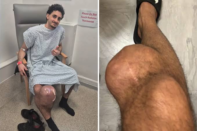 Man Notices Small Lump on Knee, Then Faces Life-Saving Decision