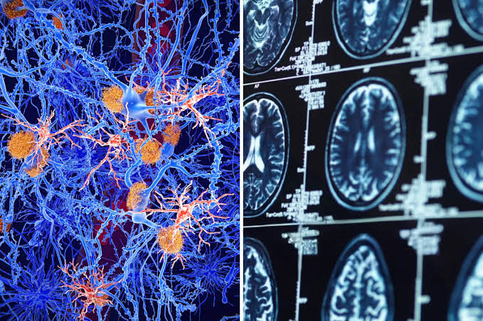 Scientists Discover How Alzheimer’s May Spread in Brain—And Way to Slow It