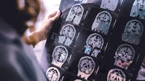 Researchers discover a possible link between the shingles vaccine and dementia prevention