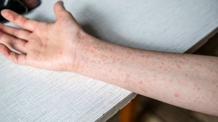 Delaware declares measles outbreak after 4 confirmed cases