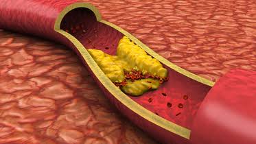High cholesterol often has no symptoms, says AHA: These 10 guidelines could help protect your heart