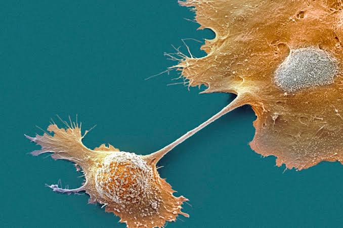 Breakthrough drug nearly doubles survival with advanced pancreatic cancer – an oncologist explains how daraxonrasib overcame an ‘undruggable’ disease
