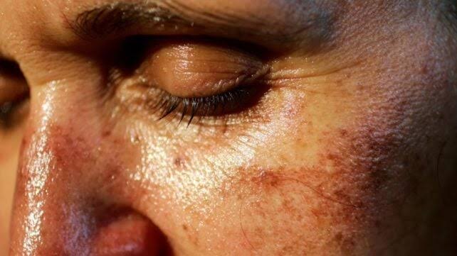 An Illegal Injectable Tanning Drug Is Trending on TikTok – And It May Be Giving People Risky Moles