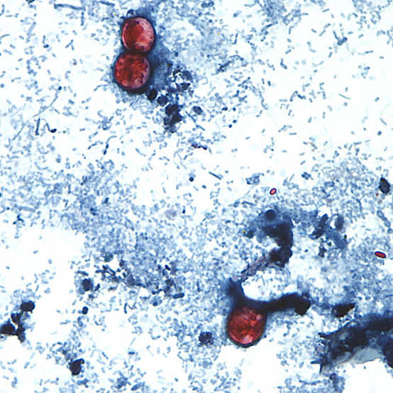 Cyclospora cases in Allegheny County rise amid national outbreak