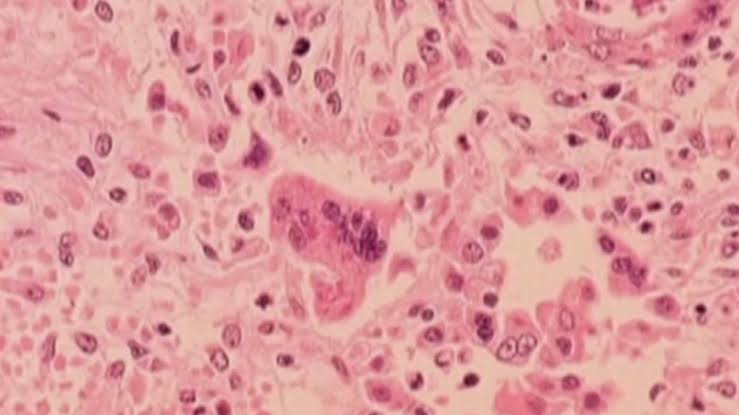 DPH confirms first case of measles in Connecticut this year
