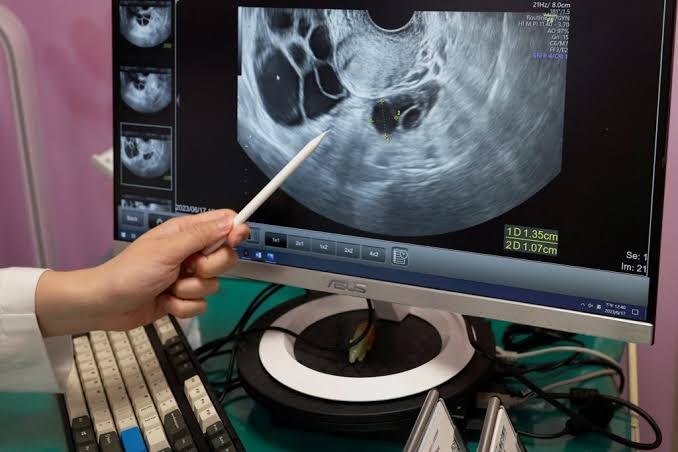 How new findings on ovarian cancer origins may help reduce risk