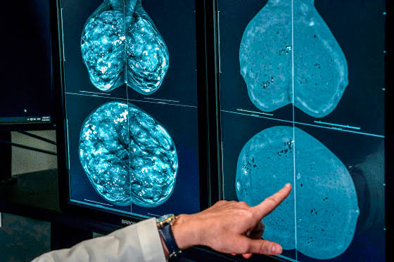 When should you get a mammogram? Conflicting advice makes it hard to know