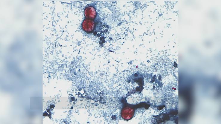 ‘Explosive’ diarrhea-causing parasite surging in Midwest, CDC says no risk in Bay Area