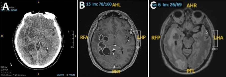 Suspected brain cancer turns out to be pork tapeworm infestation