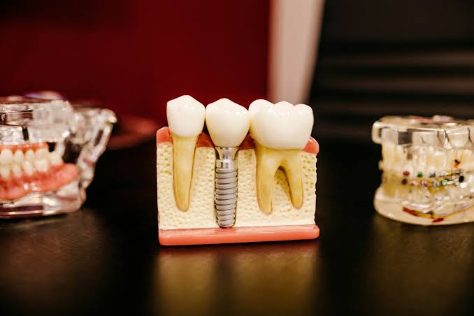 Titanium particles may explain why antibiotics fail against dental implant infections