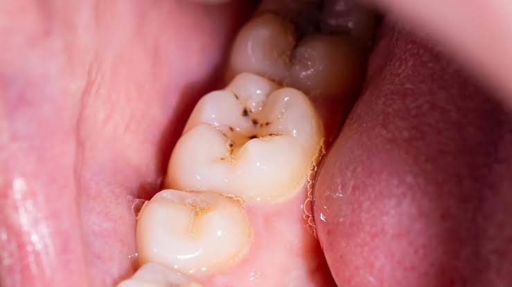Goodbye, cavities? New gel could regrow tooth enamel