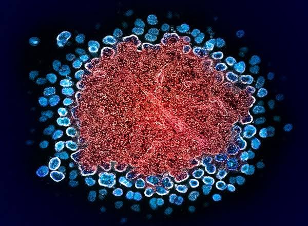 Person functionally cured of HIV after bone marrow transplant from sibling