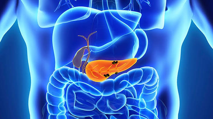 RAS Drug Nearly Doubles Survival in Mets Pancreatic Cancer