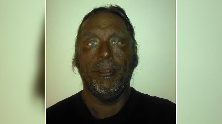 "Breaking New Ground": Man Reveals Results After Injecting Himself With Unregulated Tanning Peptide Melanotan 2
