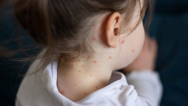 Maricopa County confirms more measles cases. Were you exposed?