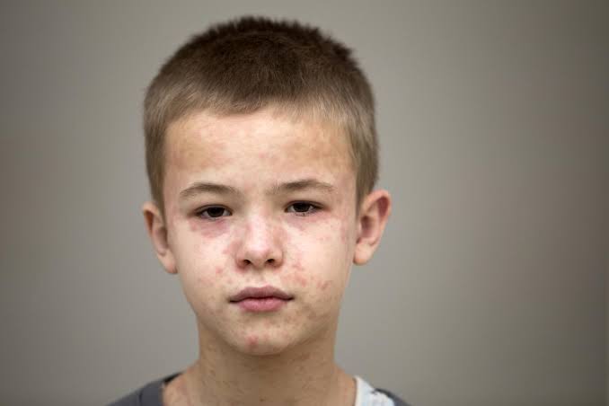 South Carolina sees no new measles activity as Utah becomes epicenter of US outbreaks
