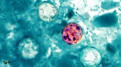 Delaware sees first Cyclosporiasis case in ongoing multistate outbreak