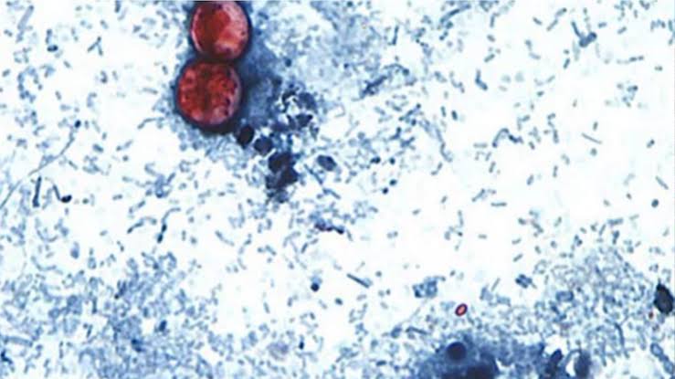 'Large and growing' parasitic infection reported in 17 states, including Pa. and NJ