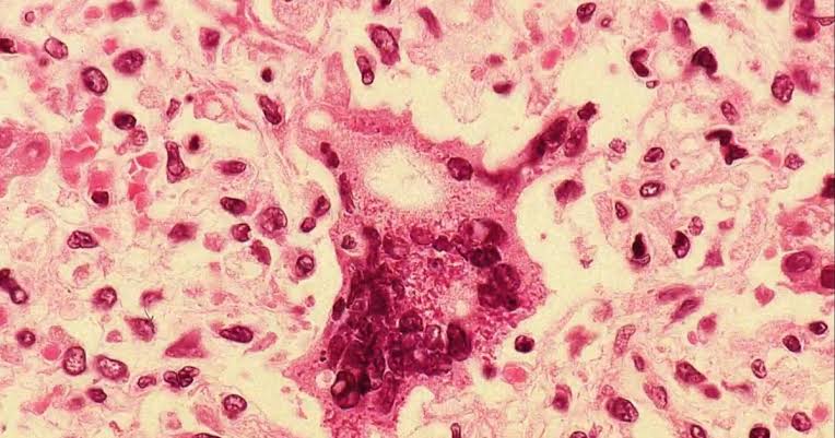 First measles case in more than 10 years confirmed in Delaware, health officials say