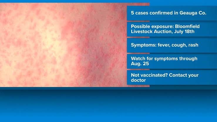 Geauga County reports 5 measles cases linked to Ohio outbreak