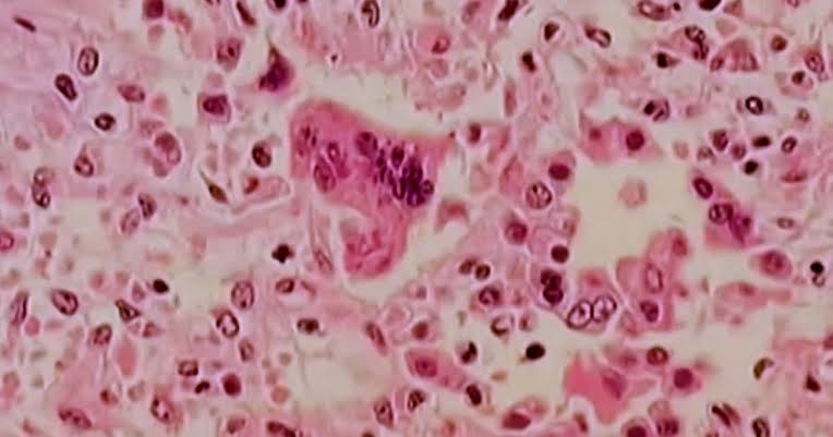 Delaware's 4 new cases of measles meet criteria of "outbreak"