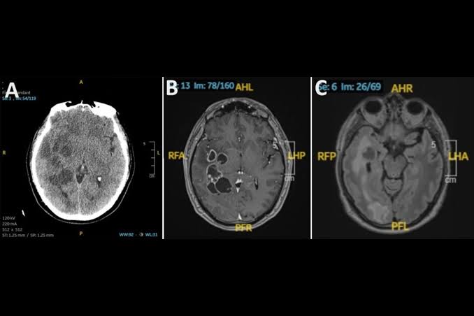 Man’s Suspected Brain Cancer Turns Out to Be Something Much Creepier