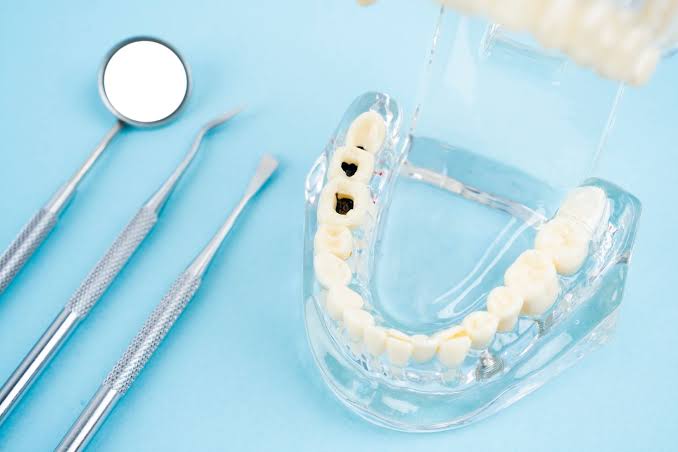 Liquid Fluoride Can Stop Cavities Without Drilling, Major Trial Finds