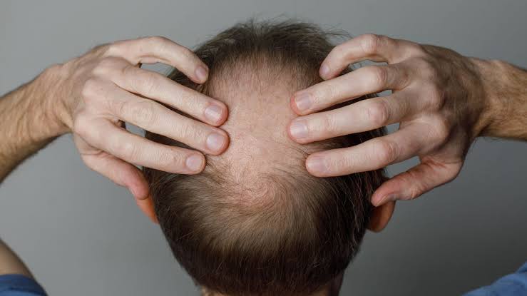 Weight loss drugs linked to increased risk of hair loss, researchers say