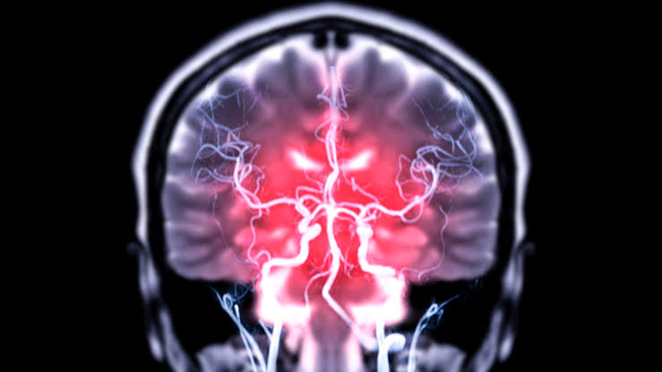 Common Hormonal Contraceptive Linked to Risk of Rare Brain Tumor