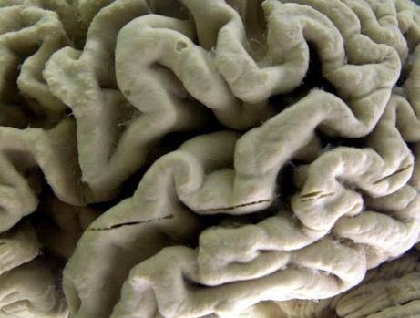 ‘This is a huge finding’: UCSD researchers work on way to prevent Alzheimer’s disease with molecular ‘switch’