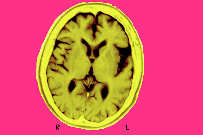 First-of-its-kind UCSF study shows blood test may catch early cognitive trouble