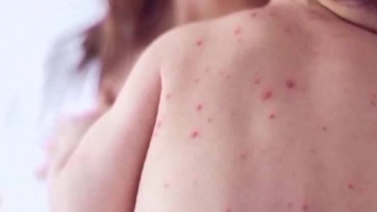 Measles is still spreading in the U.S., with more than 2,000 cases this year