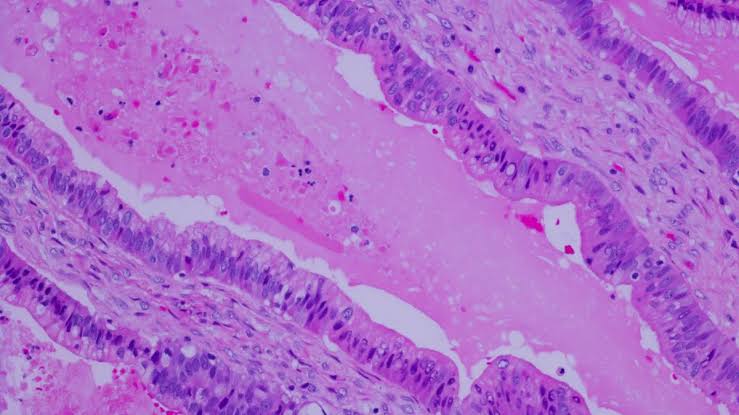 ‘Unprecedented’ Revolution data point to paradigm shift in pancreatic cancer