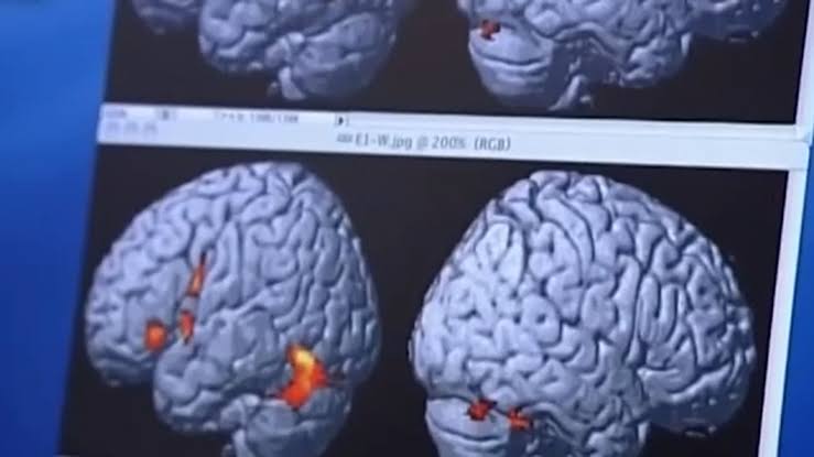 Preventing dementia | Healthy midlife habits could delay dementia by up to 13 years, study finds