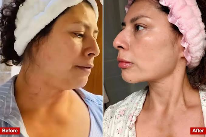 Exclusive | Meet the women performing at-home liposuction on themselves with shady $95 kits to shed weight